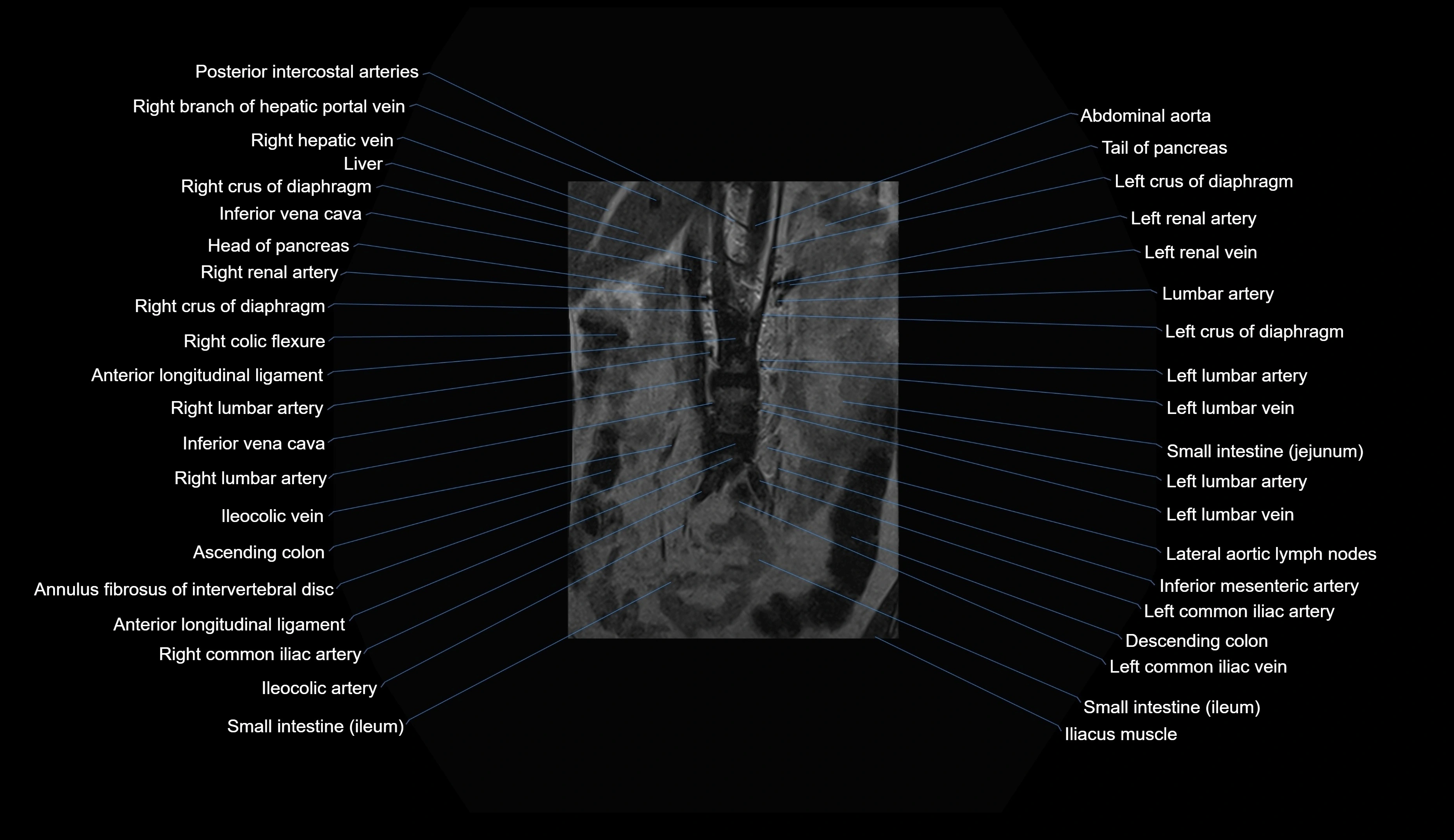 MRI lumbar spine coronal cross sectional anatomy 3T radiology  image-img-00001-00004.webp
